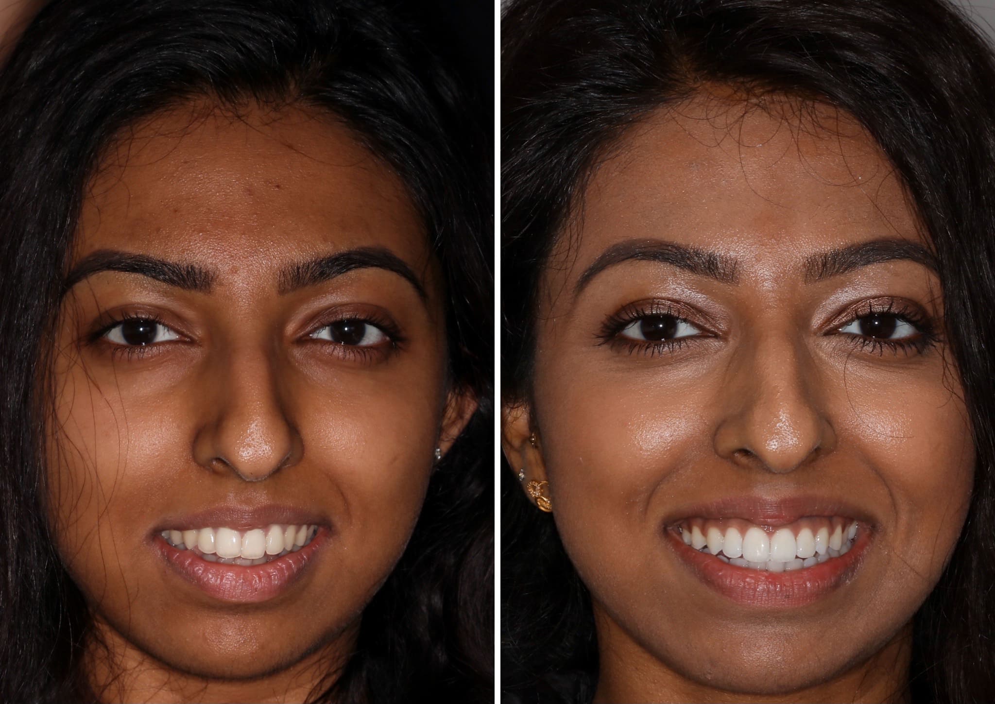 No1 Smile Makeover Treatment in bareilly, No1 Smile Makeover Treatment in UP