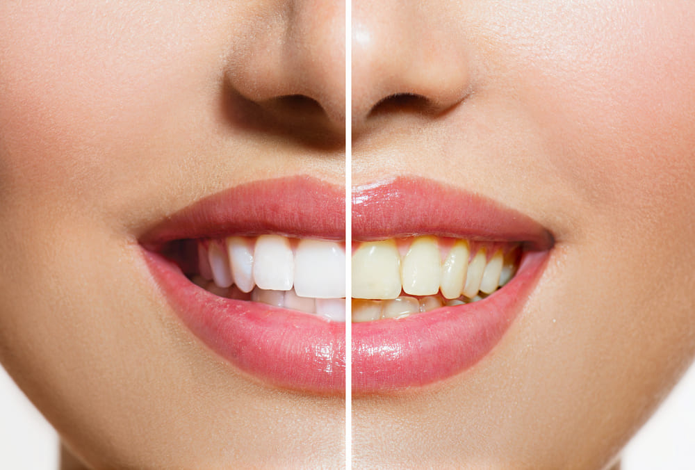No1 Teeth-Whitening Services in bareilly, No1 Teeth-Whitening Services in UP