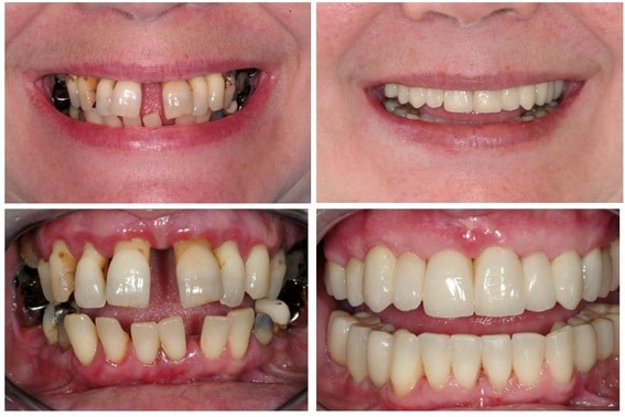 No1 Teeth-Whitening Services in India, Top Teeth-Whitening Services in bareilly