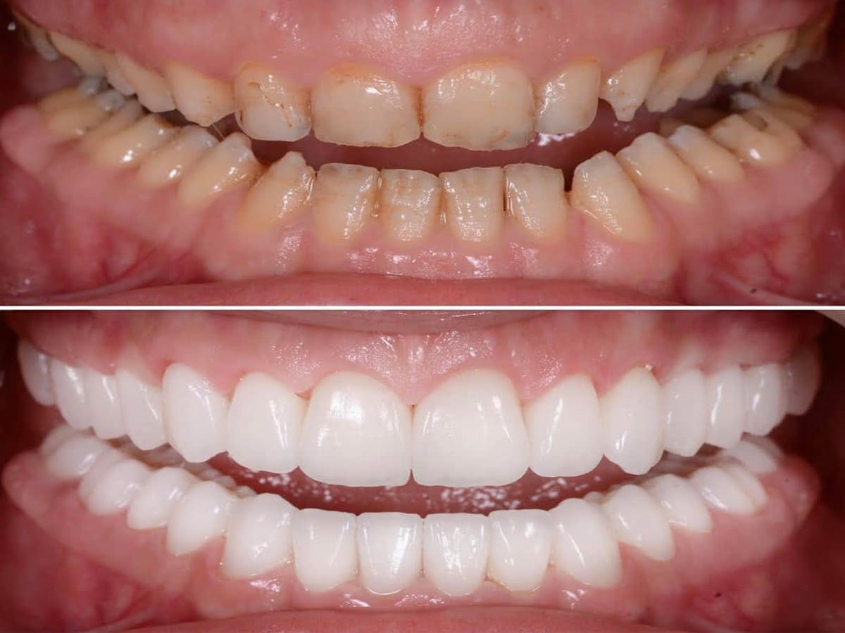 Best Teeth-Whitening Services in UP, Best Teeth-Whitening Services in India