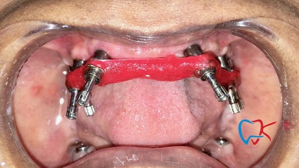No1 Dental Implant Treatment in India, Top Dental Implant Treatment in bareilly
