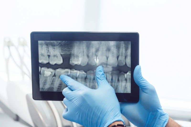 Top Root Canal Treatment in UP,Top Root Canal Treatment in India