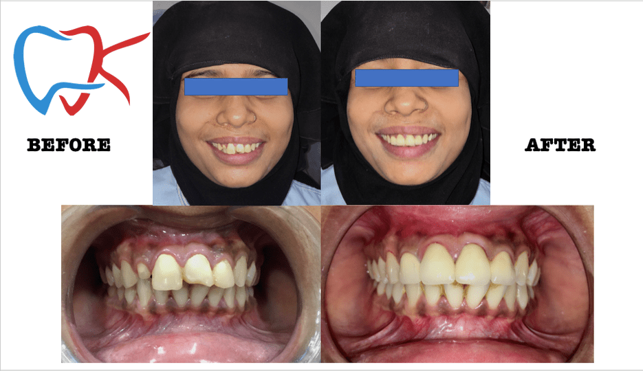 No1 Smile Makeover Treatment in India, Top Smile Makeover Treatment in bareilly