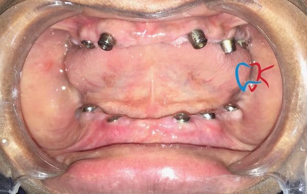No1 Dental Implant Treatment in bareilly, No1 Dental Implant Treatment in UP